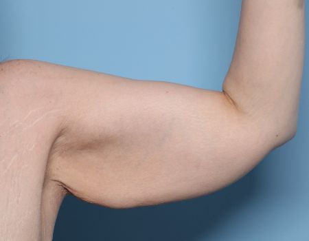 before left arm brachioplasty front view female patient case 2992