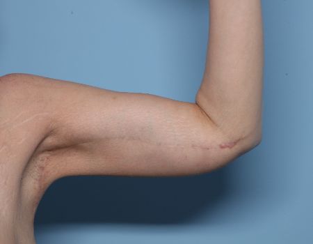 after left arm brachioplasty front view female patient case 2992