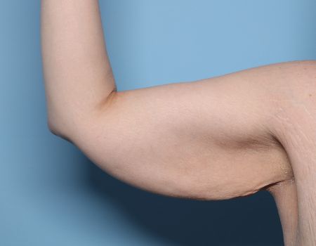 before right arm brachioplasty front view female patient case 2992
