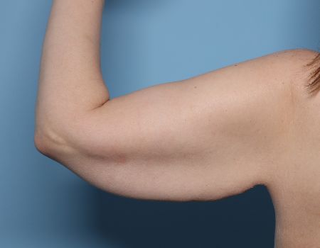 before left arm brachioplasty back view female patient case 2992