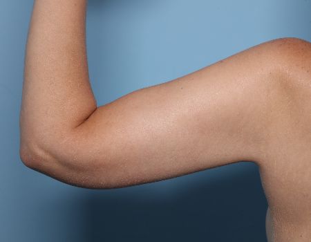 after left arm brachioplasty back view female patient case 2992