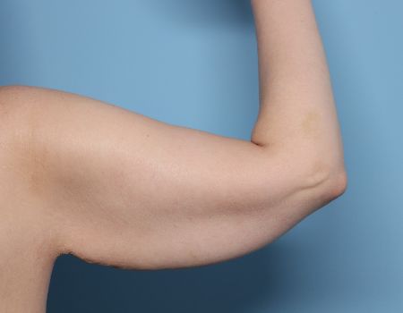 before right arm brachioplasty back view female patient case 2992