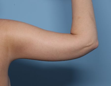 after right arm brachioplasty back view female patient case 2992