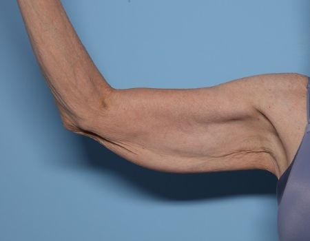 before arm lift right arm front side female patient case 3015