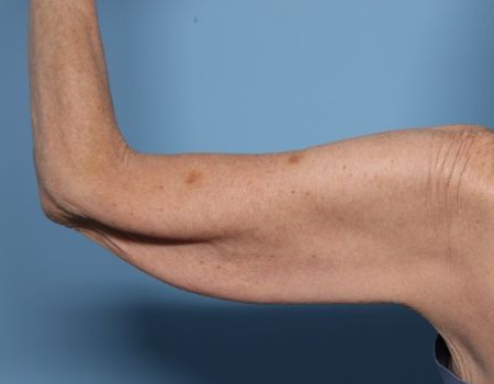 before arm lift left arm back side female patient case 3015