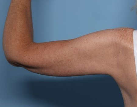 after arm lift left arm back side female patient case 3015