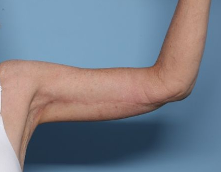 after arm lift left arm front side female patient case 3015