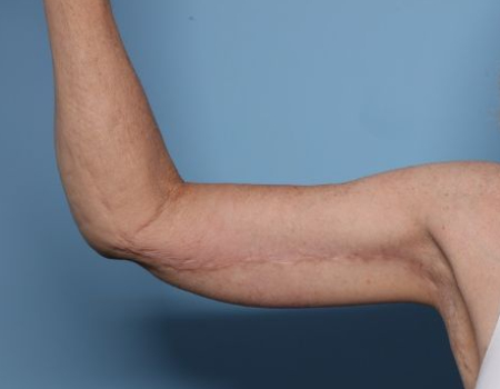 after arm lift right arm front side female patient case 3015