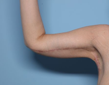 after right arm brachioplasty front view female patient case 2992