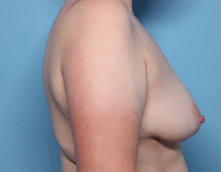 before breast lift with augmentation right view female patient case 3211