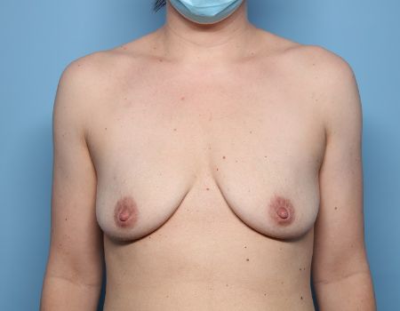 before breast lift with augmentation front view female patient case 3230