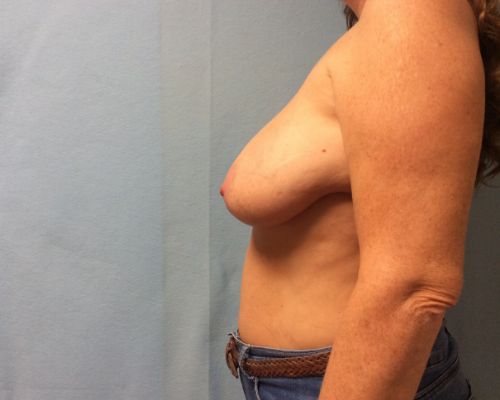 before breast reconstruction left view female patient case 3027