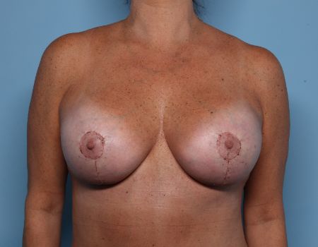 after breast revision front view female patient case 3109
