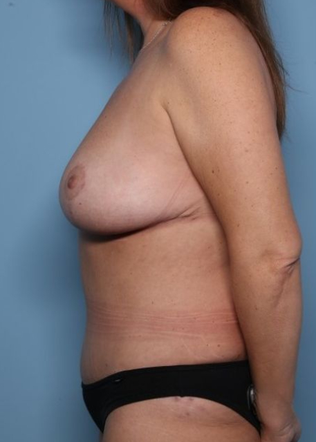 after mommy makeover left side view female patient case 2868