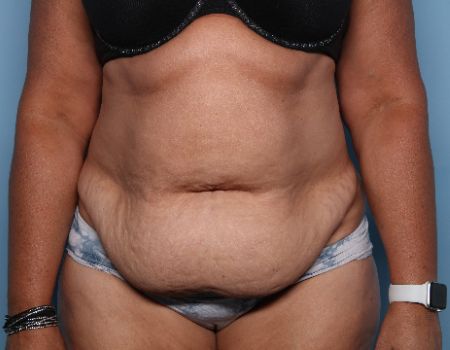 before tummy tuck front view female patient case 2957