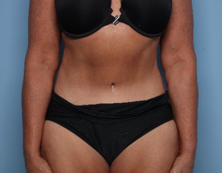 after tummy tuck front view female patient case 2957