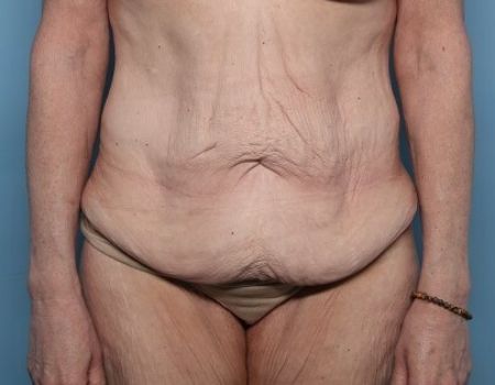 before tummy tuck female patient front view case 2970
