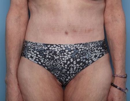 after tummy tuck female patient front view case 2970