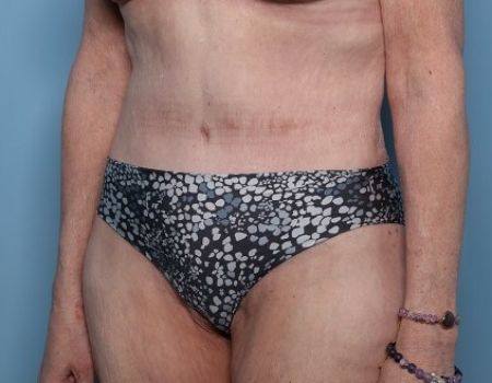 after tummy tuck female patient angle view case 2970