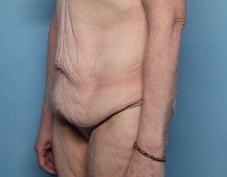 before tummy tuck female patient angle view case 2970