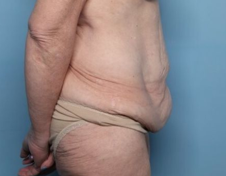 before tummy tuck female patient side view case 2970