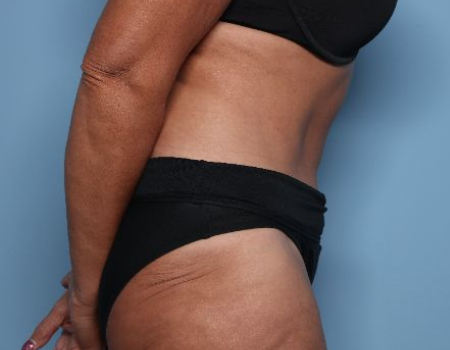 after tummy tuck side view female patient case 2957