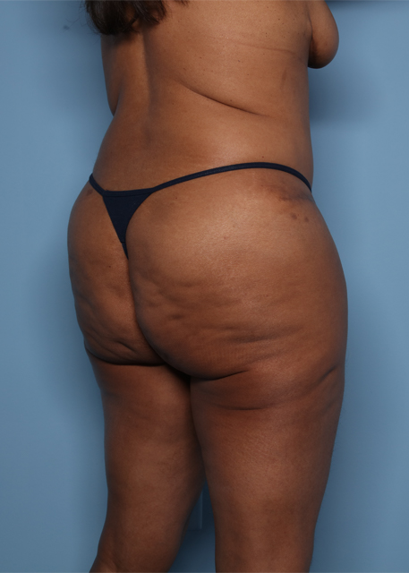 before Lower back lift and and BBL female patient angle view case 4487