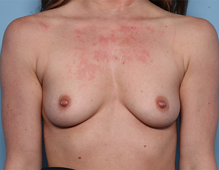 before breast augmentation female patient front view case 4473