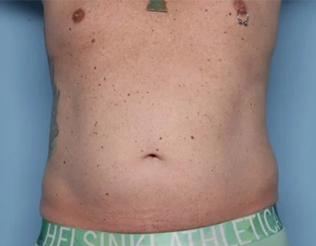 Before 360 Body Lift with High Definition LipoSculpting male patient front view case 4516