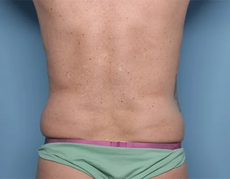 Before 360 Body Lift with High Definition LipoSculpting male patient back view case 4516