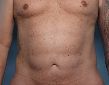 After 360 Body Lift with High Definition LipoSculpting male patient front view case 4516