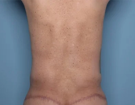 After 360 Body Lift with High Definition LipoSculpting male patient back view case 4516