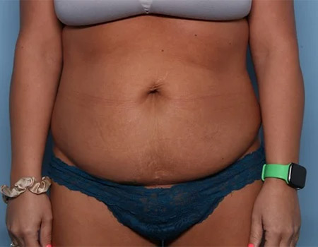 before tummy tuck front view female patient case 4490