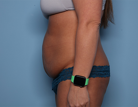 before tummy tuck side view female patient case 4490