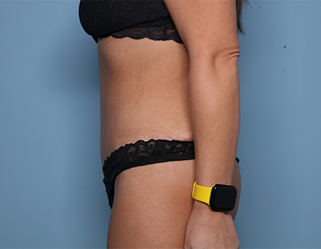 after tummy tuck side view female patient case 4490