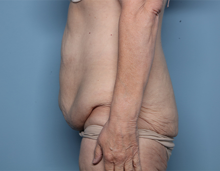 before tummy tuck side view female patient case 4495