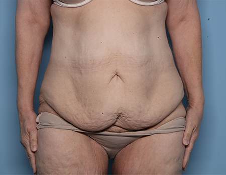 before tummy tuck front view female patient case 4495
