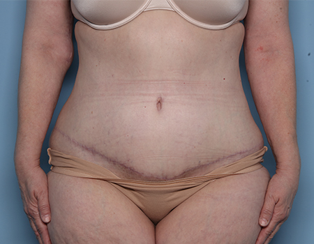 after tummy tuck front view female patient case 4495