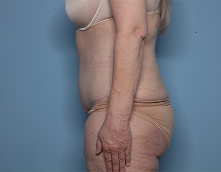 after tummy tuck side view female patient case 4495