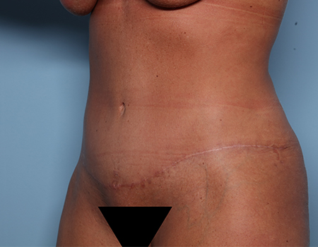 after tummy tuck angle view female patient case 4500
