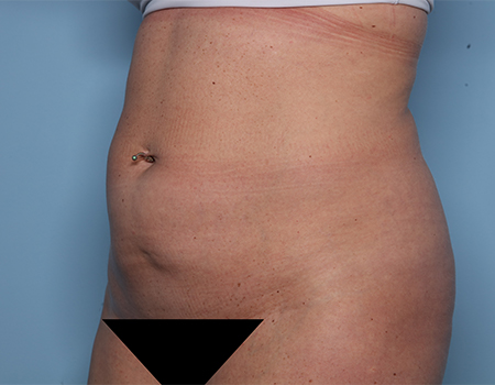 before tummy tuck angle view female patient case 4500