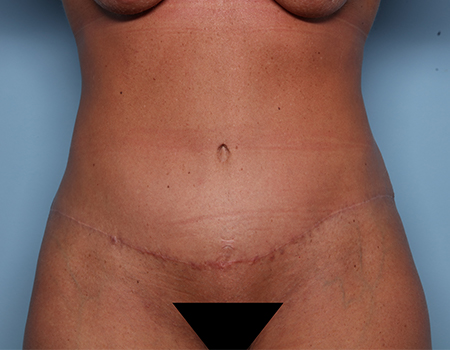 after tummy tuck front view female patient case 4500