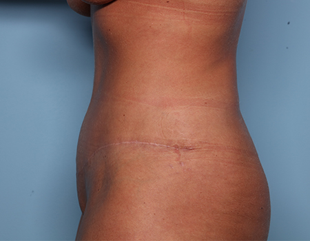 after tummy tuck side view female patient case 4500