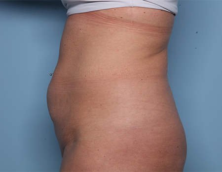 before tummy tuck side view female patient case 4500