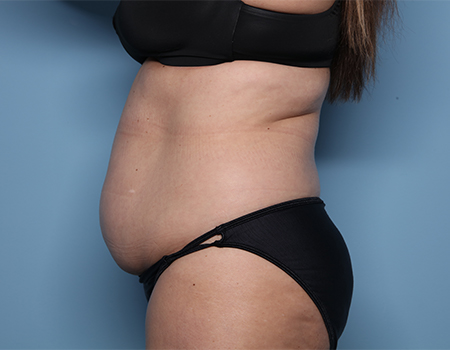 before tummy tuck side view female patient case 4507