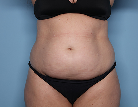 Before tummy tuck front view female patient case 4507